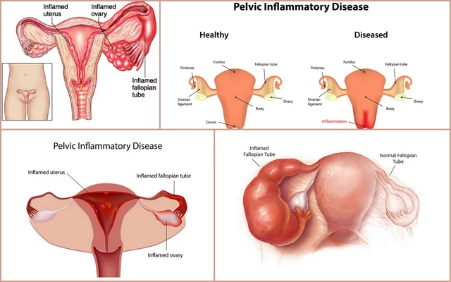 The use of clavulanate in the management of pelvic inflammatory disease