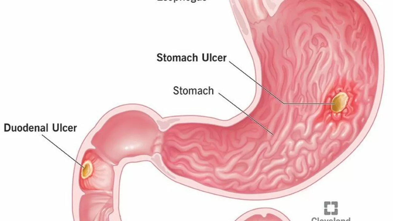The Pros and Cons of Using Sucralfate for Stomach Ulcers